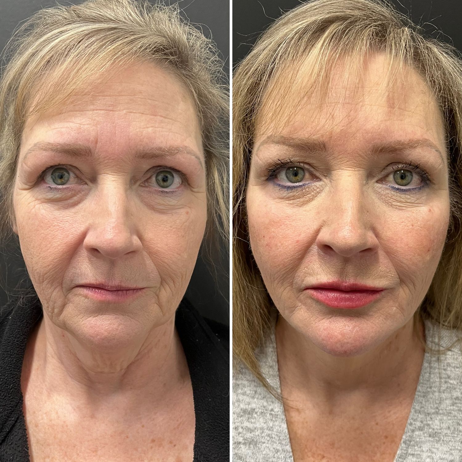 indianapolis dermal fillers patient before & after