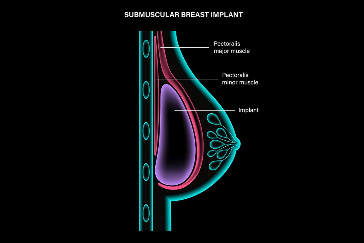 anatomy of the breast with implant