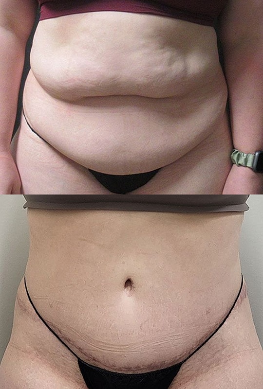 Comparison of abdomen before and after changes
