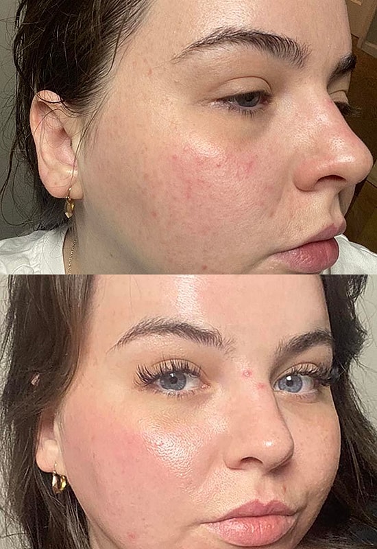 Before and after skin transformation photos.