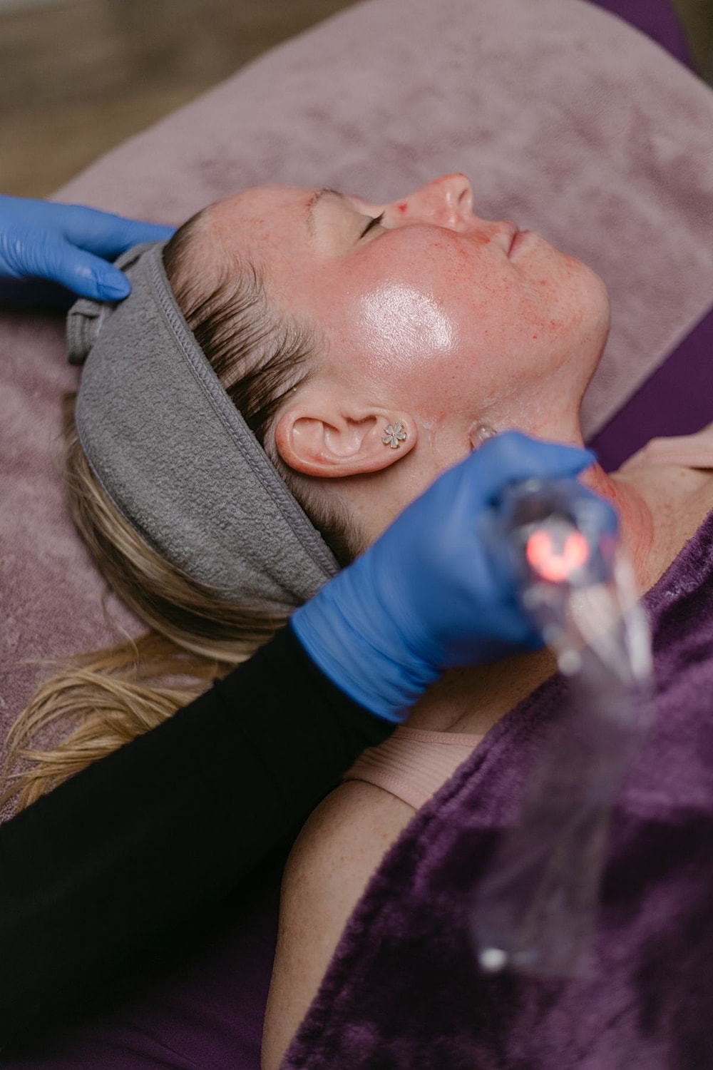 Woman receiving a facial treatment with microneedling.