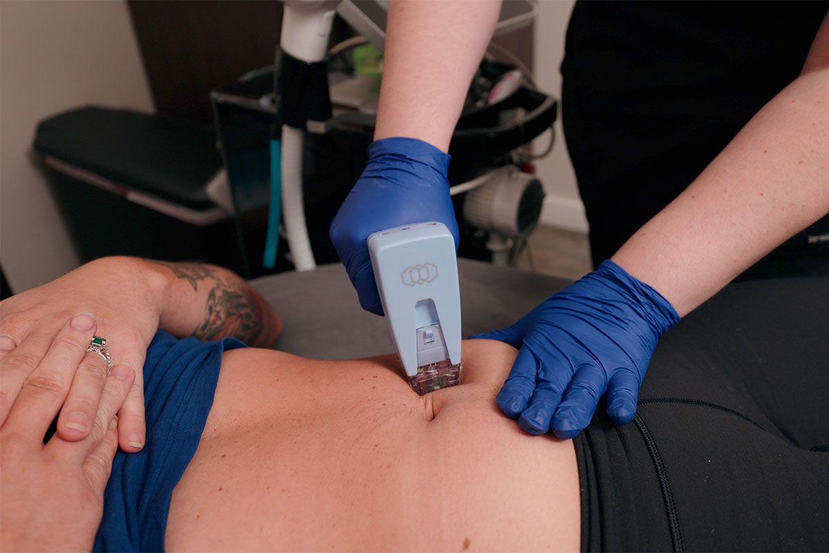 indianapolis morpheus8 body patient receiving treatment