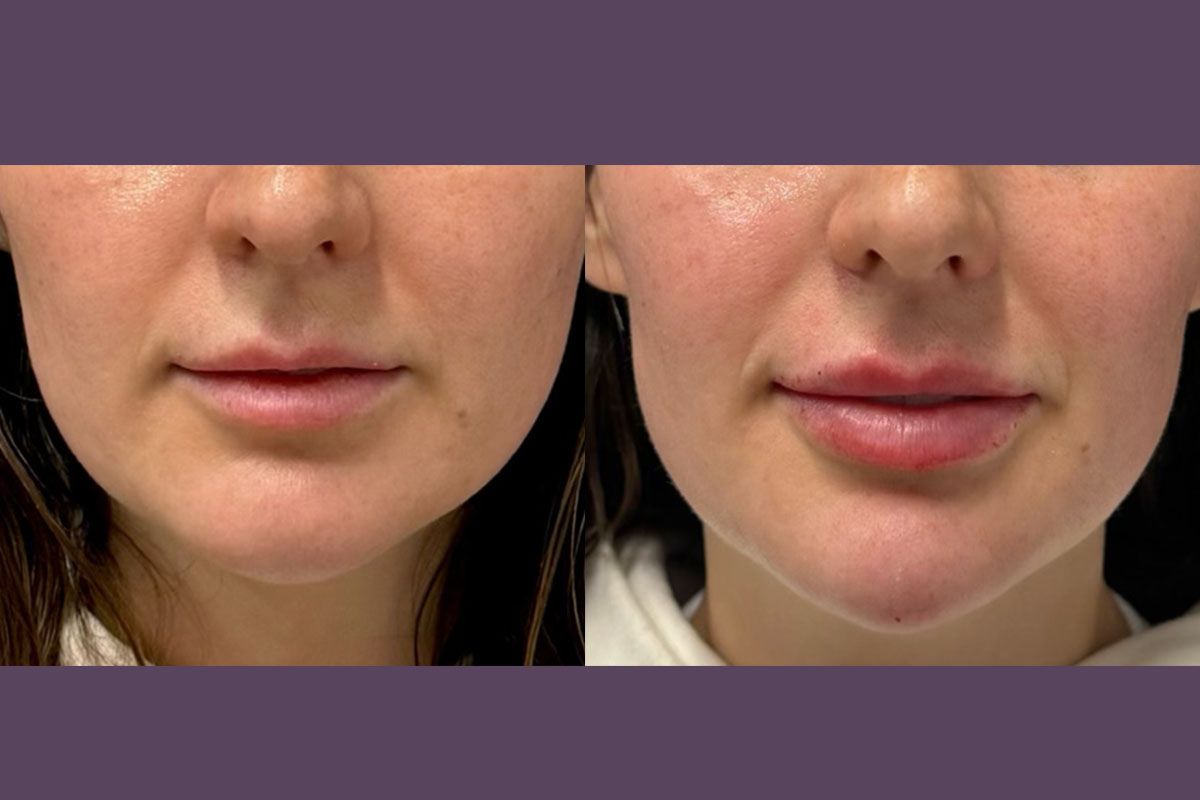 indianapolis dermal fillers patient before and after