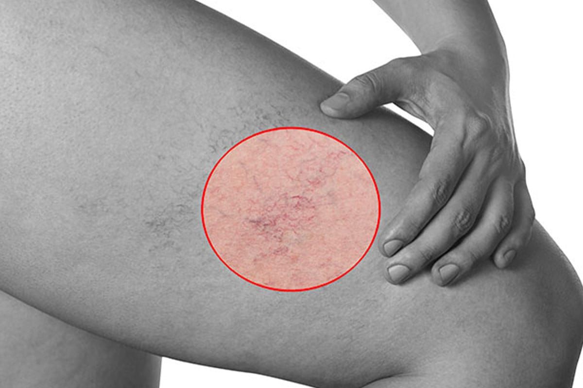 spider veins on a patients thigh