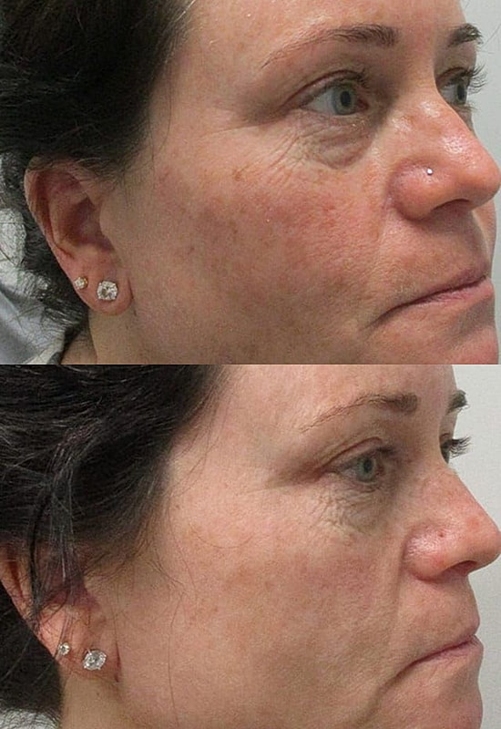 Before and after facial treatment comparison image.
