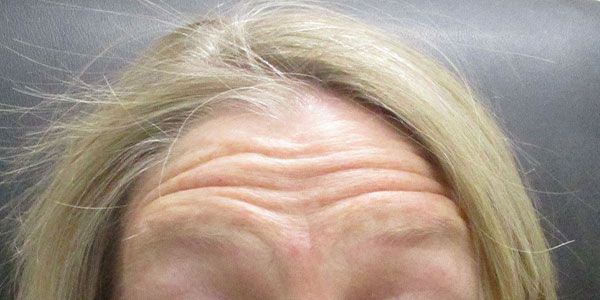 Xeomin Before & After