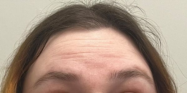 Xeomin Before & After