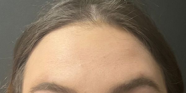 Xeomin Before & After