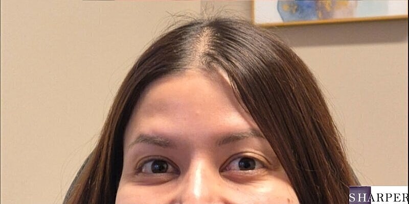 Xeomin Before & After