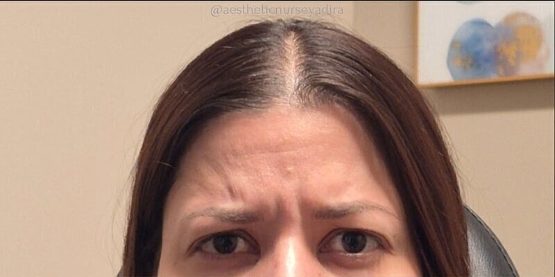 Xeomin Before & After