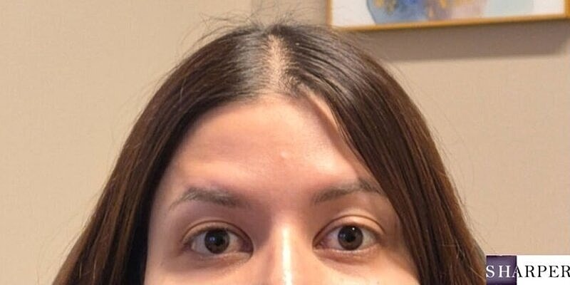 Xeomin Before & After