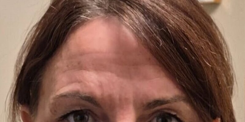 Xeomin Before & After