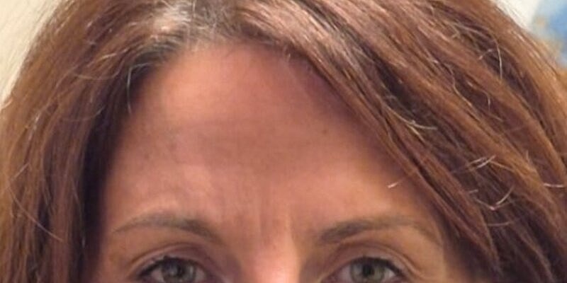 Xeomin Before & After