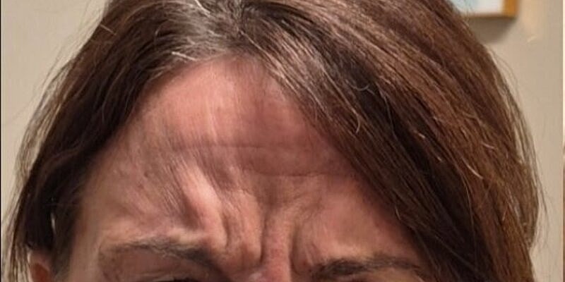 Xeomin Before & After