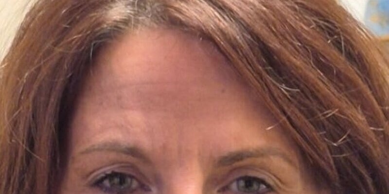 Xeomin Before & After