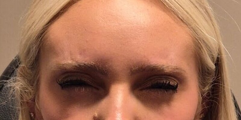 Xeomin Before & After