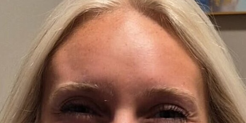 Xeomin Before & After