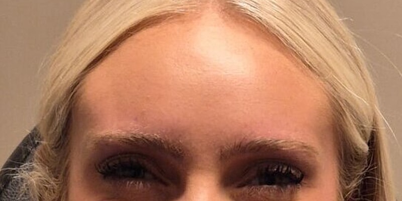 Xeomin Before & After