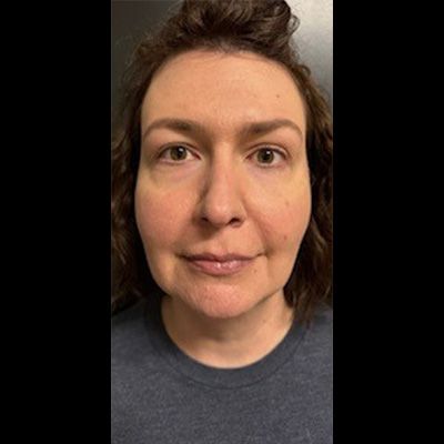 Ultimate Neck Package Before & After