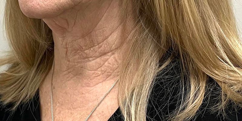 Ultimate Neck Package Before & After