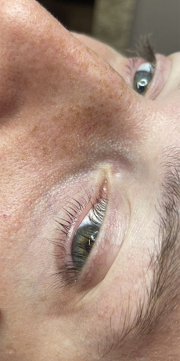 Spider Vein Treatment Before & After