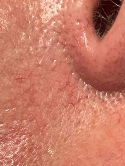 Spider Vein Treatment Before & After