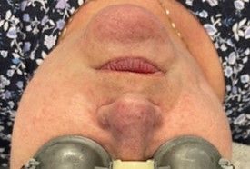 Spider Vein Treatment Before & After