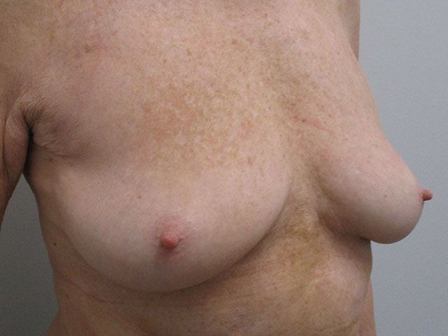 Breast Lift Before & After