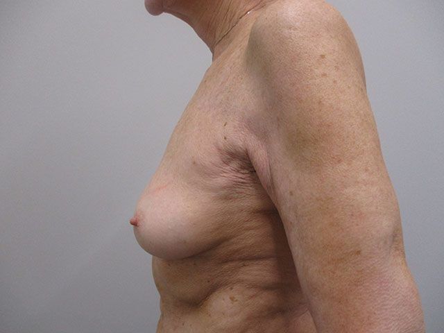 Breast Lift Before & After