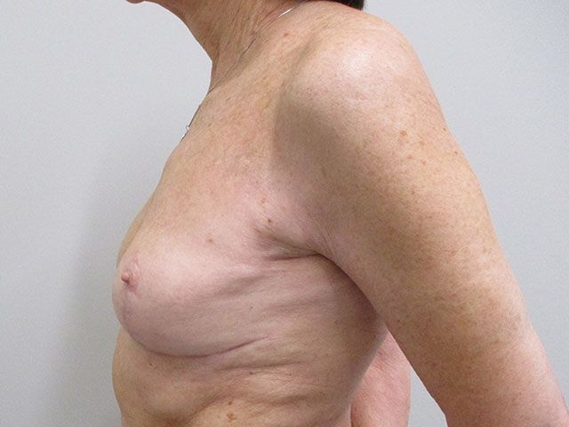 Breast Lift Before & After