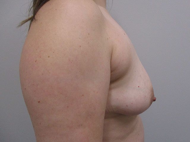 Breast Lift Before & After