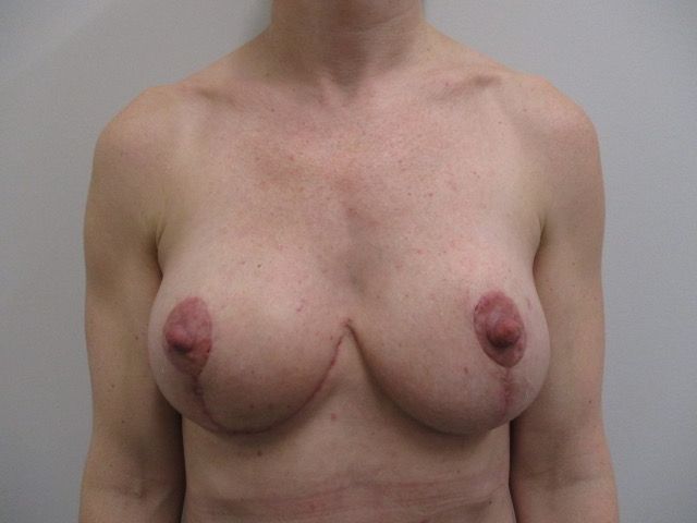 Breast Lift Before & After