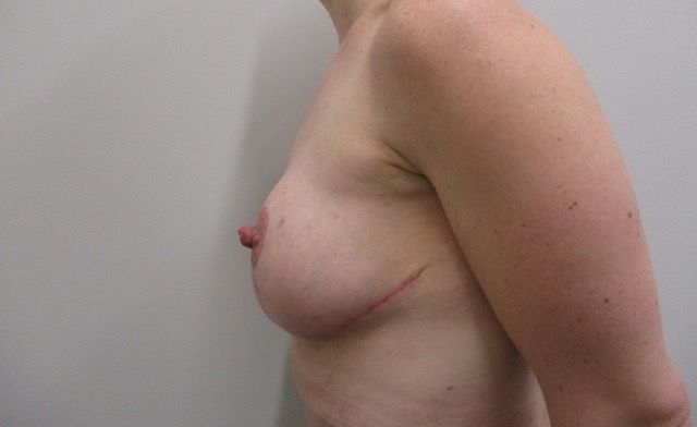 Breast Lift Before & After
