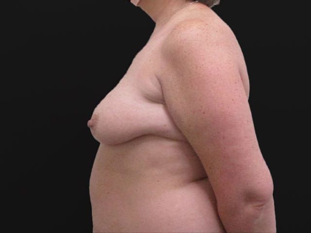 Breast Lift Before & After