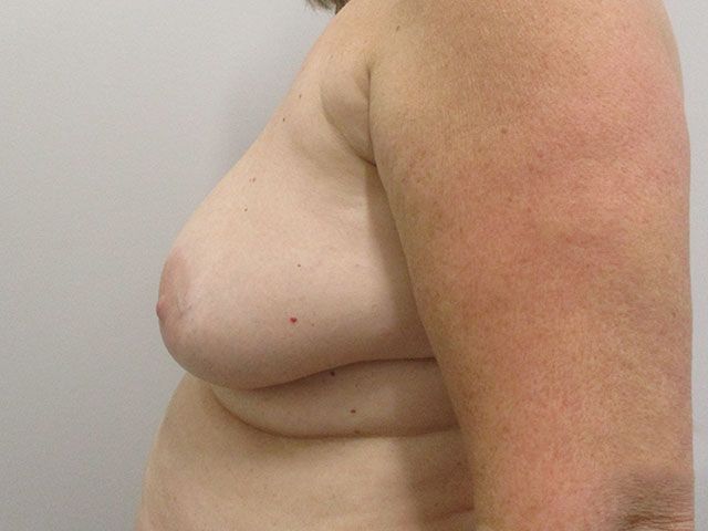 Breast Lift Before & After