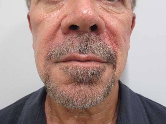 Lower Face Before & After