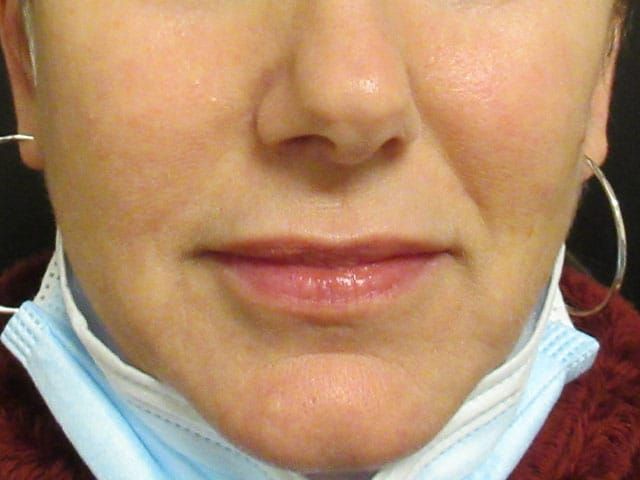 Lower Face Before & After
