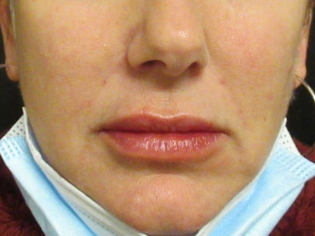 Lower Face Before & After