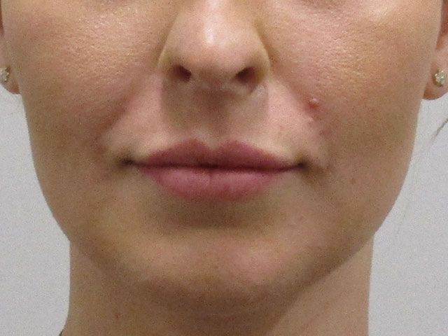 Lower Face Before & After