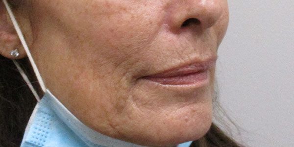 Lower Face Before & After