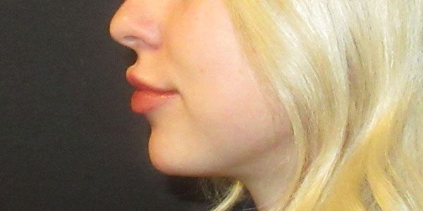 Lower Face Before & After