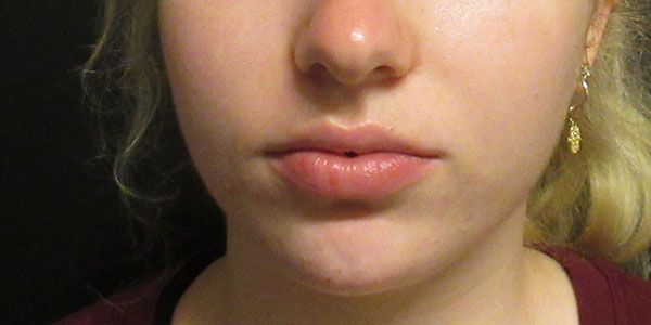 Lower Face Before & After