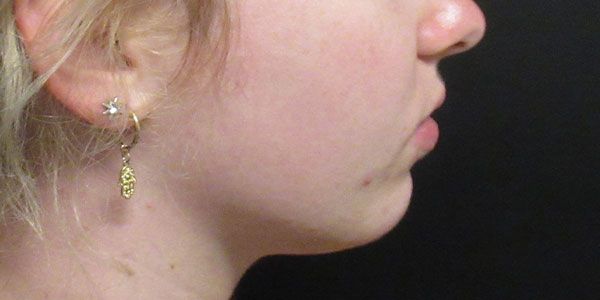 Lower Face Before & After