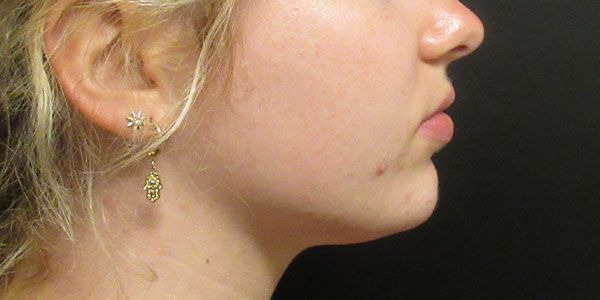 Lower Face Before & After