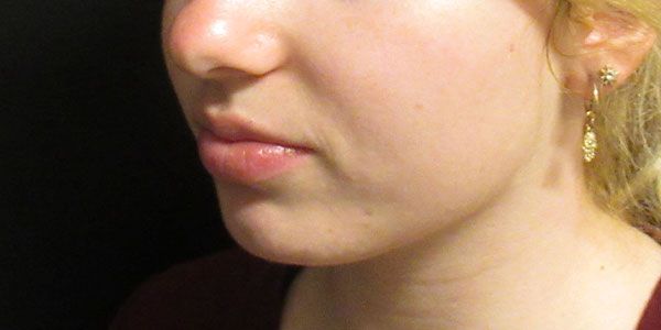 Lower Face Before & After