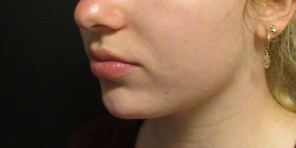 Lower Face Before & After