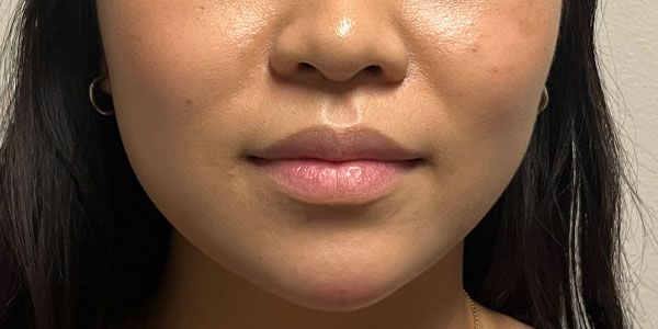 Lower Face Before & After