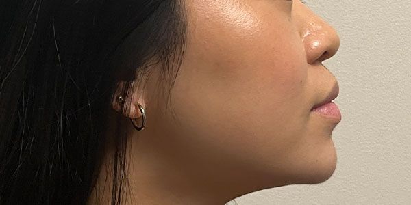 Lower Face Before & After