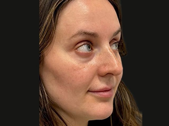 Lower Face Before & After