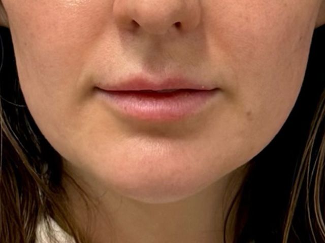 Lower Face Before & After